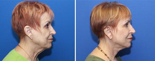 browlift, facelift and necklift with CO2 laser peel of mouth and lower eyelids